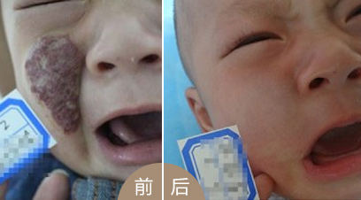 Ӥ׶ѪͼƬ